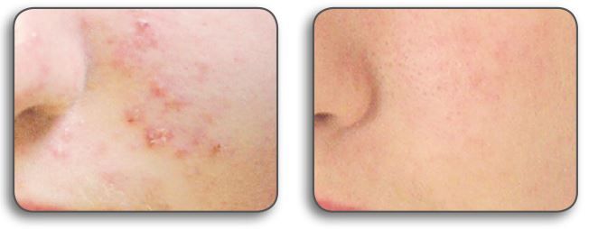 Divaverde Nürnberg - Hightech-Anwendungen für Ihre Schönheit - Akne