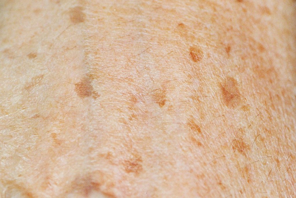 Divaverde Nürnberg - Anwendungen für Ihre Schönheit – Altersflecken