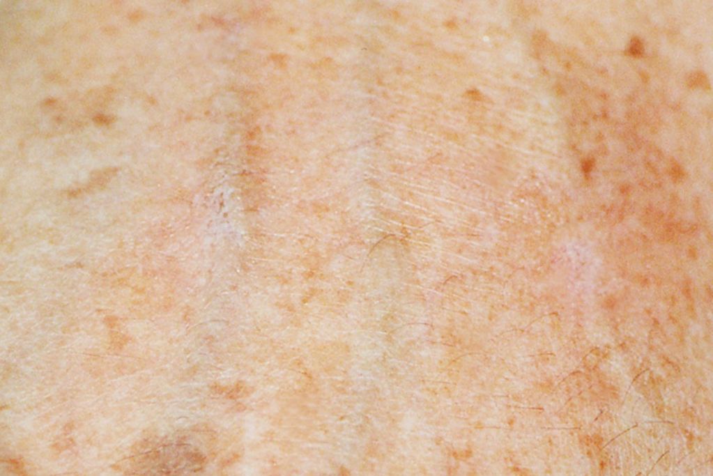 Divaverde.de - Altersflecken