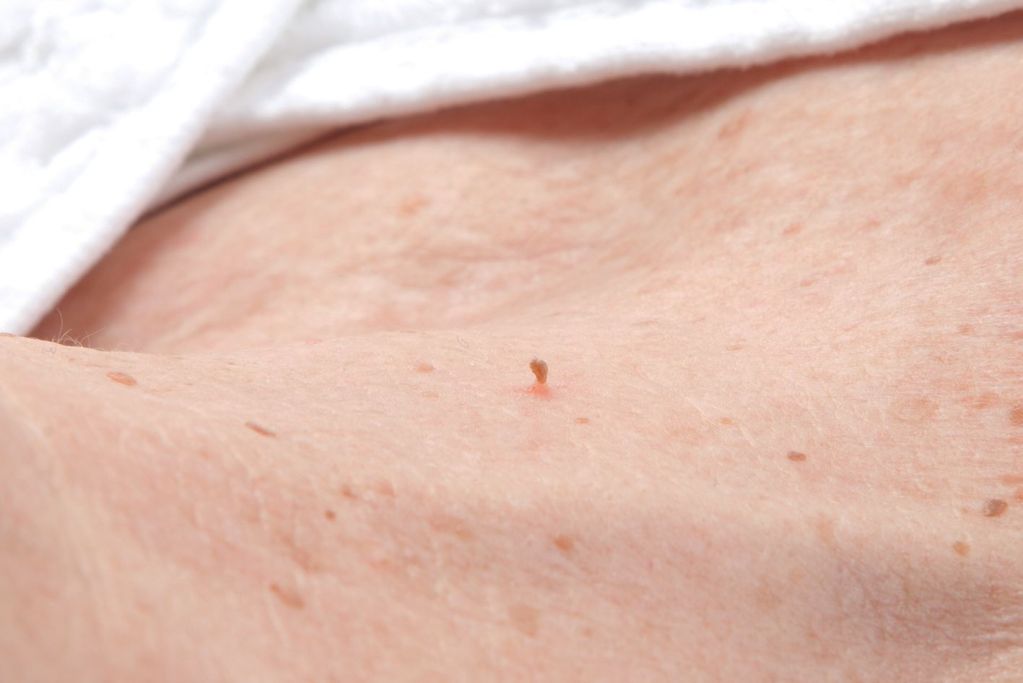 Divaverde.de - Anwendungen für Ihre Schönheit – Fibroma