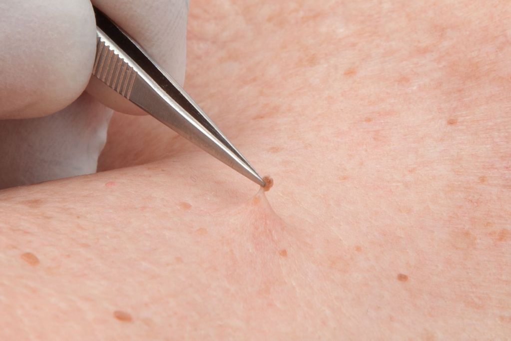 Divaverde.de - Fibroma