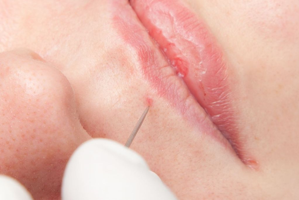 Divaverde.de - Anwendungen für Ihre Schönheit – Blutschwämmchen