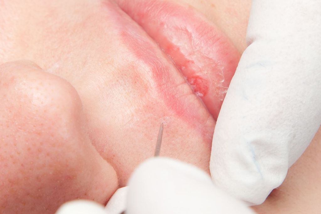 Divaverde.de - Blutschwämmchen