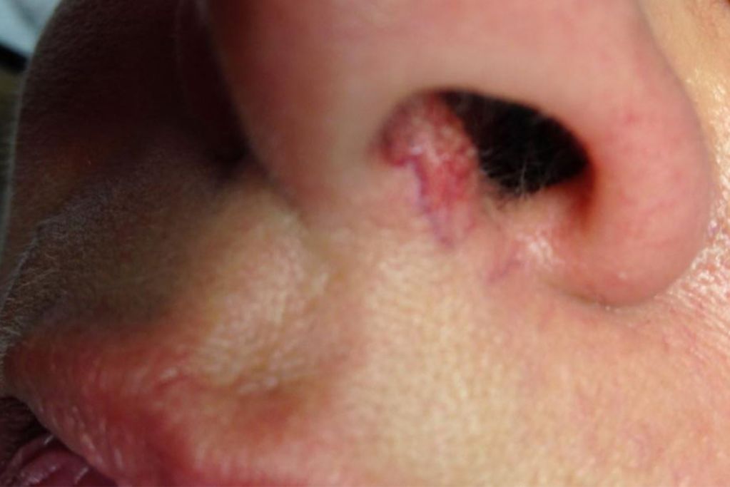 Divaverde.de - Anwendungen für Ihre Schönheit – Äderchen/Couperose