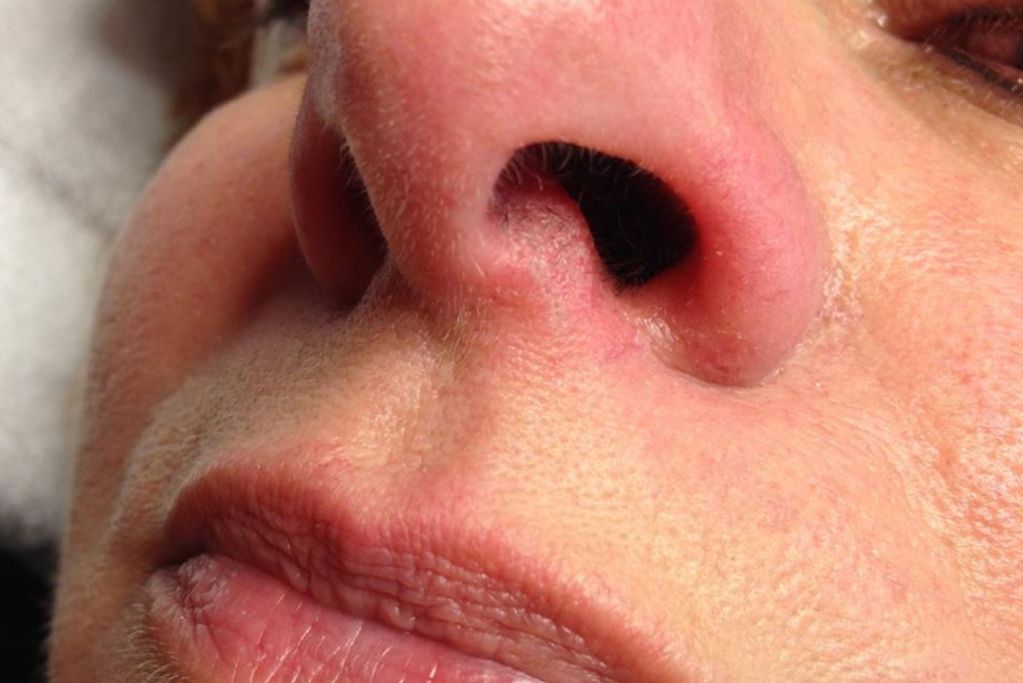 Divaverde.de - Äderchen/Couperose