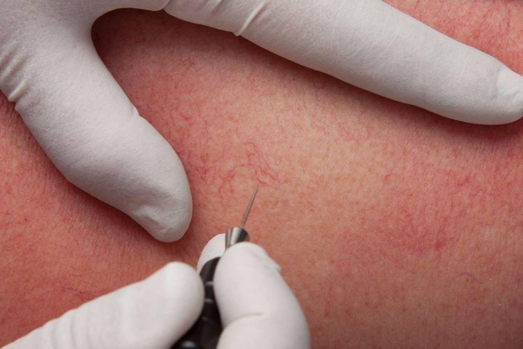 Divaverde.de - Anwendungen für Ihre Schönheit – Couperose