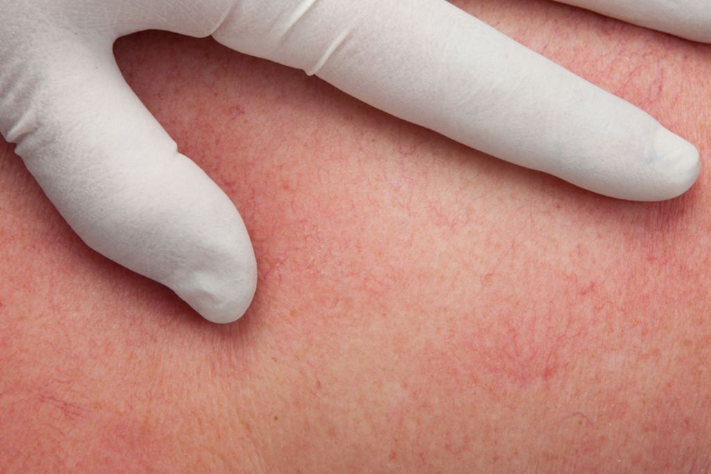 Divaverde.de - Couperose